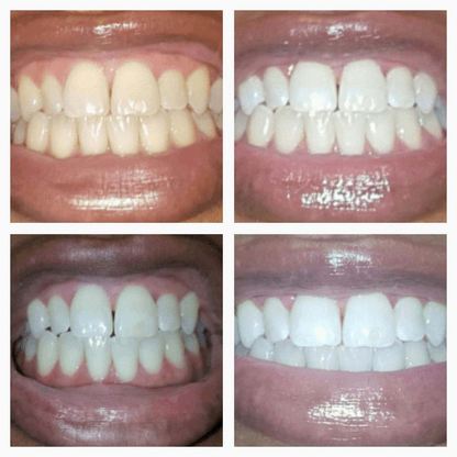 LOVILDS™Extra-Strength Teeth Whitening Serum Pen + Dual-Peroxide Formula & Xylitol