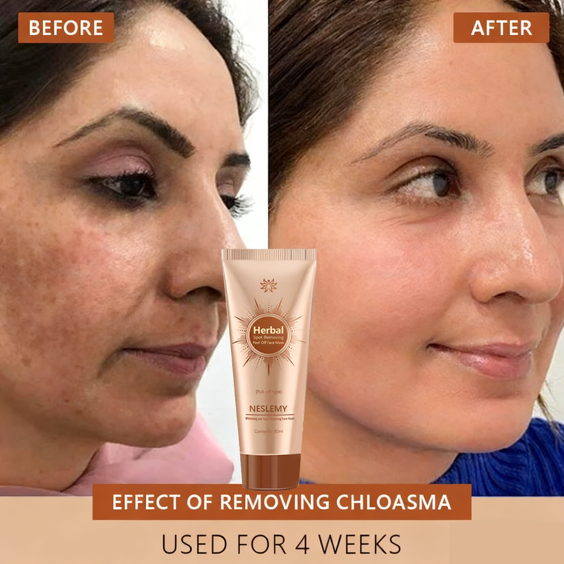 Whitening & Spot-Removing Mask – 👩‍⚕️ Natural Ingredients for Age Spots, Freckles, and Sun Spots