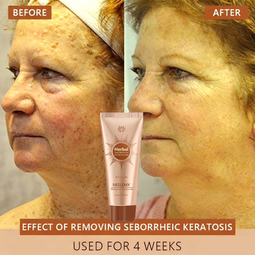 Whitening & Spot-Removing Mask – 👩‍⚕️ Natural Ingredients for Age Spots, Freckles, and Sun Spots