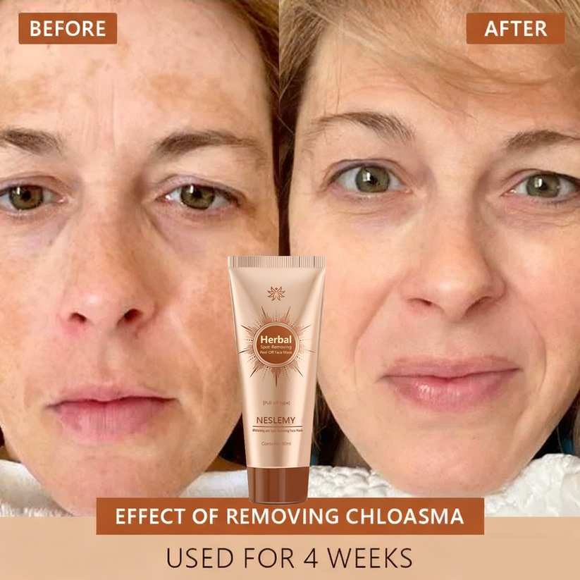 Whitening & Spot-Removing Mask – 👩‍⚕️ Natural Ingredients for Age Spots, Freckles, and Sun Spots