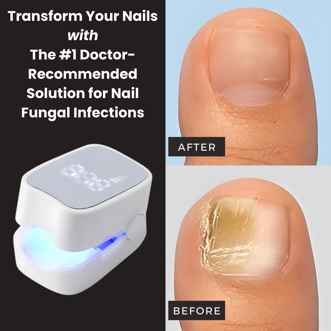 TIWORLD™ - Nail Fungus Laser Device -More scientific nail care