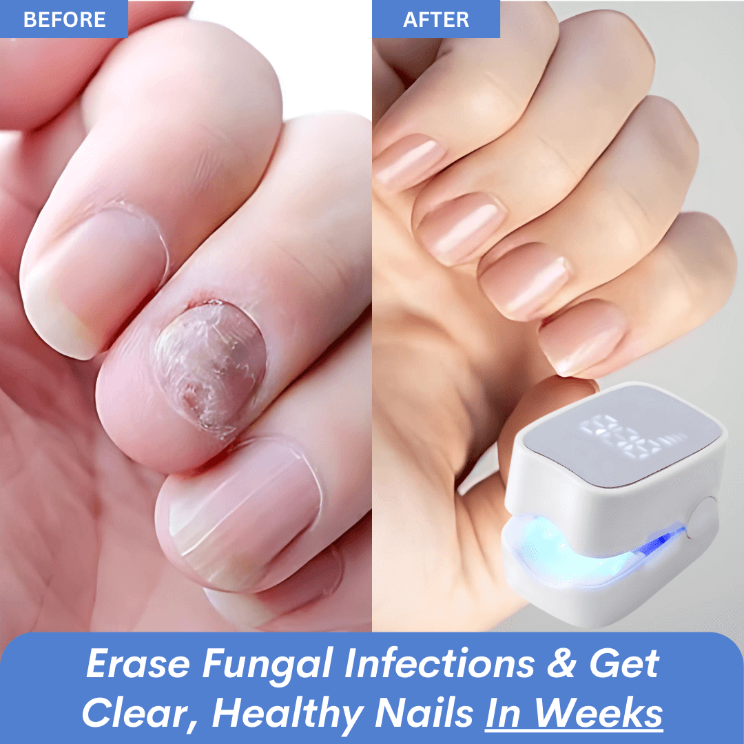 TIWORLD™ - Nail Fungus Laser Device -More scientific nail care