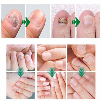 LOVILDS Natural Nail Fungus Treatment Gel - Fungus Cream, Multi-Purpose Nail Repair