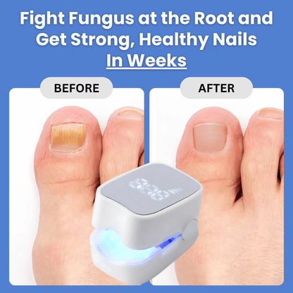 TIWORLD™ - Nail Fungus Laser Device -More scientific nail care